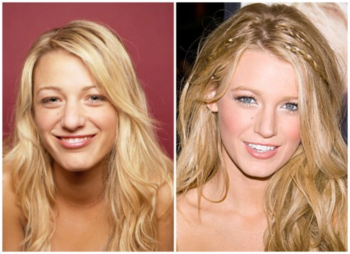 Blake-Lively-Plastic-Surgery-Before-And-After-Nose-Job-Rhinoplasty-Kiev-Ukraine
