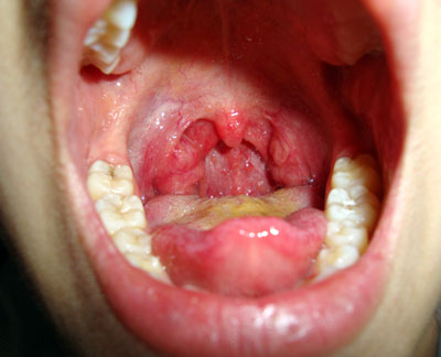 Абсцесс зуба - симптомы, причины и виды лечения ДЕНТиК ЛЮКС