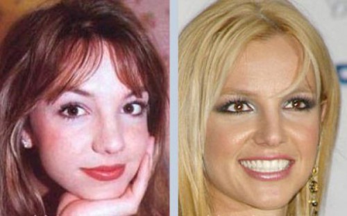 ENT surgery Rhinoplasty Kiev Ukraine Britney Spears