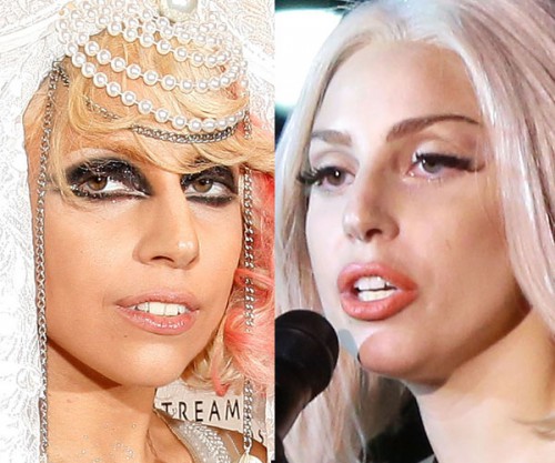 Lady-Gaga-Plastic-Surgery-Before-And-After-Nose-Job-Rhinoplasty-Kiev-Ukraine