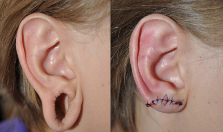 ear-lobe-repair-kiev