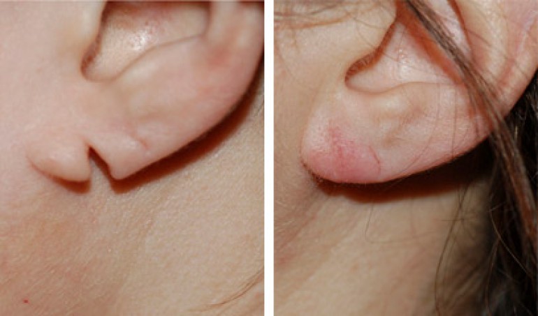 ear lobe correction