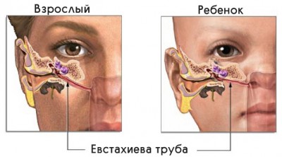 Воспаление слуховой трубы