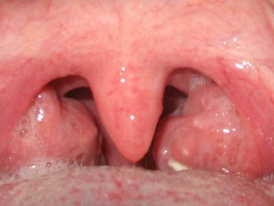 Першение в горле и сухой кашель: причины, лечение, профилактика - Медицинский центр Active Medical