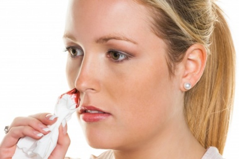 Перша допомога при кровотечі з носа: ефективні поради