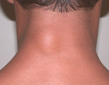 Разбираемся в причинах и особенностях шишек на спине
