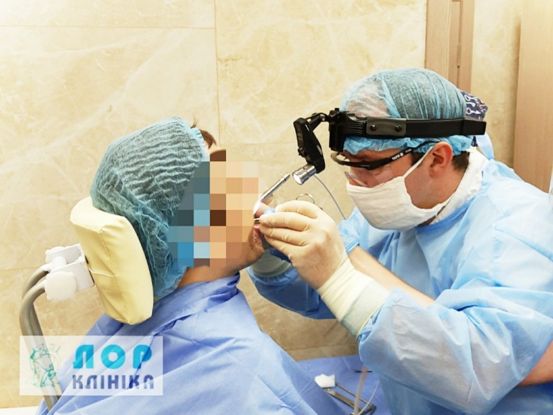 Лазерная тонзиллэктомия (удаление небных миндалин (гланд)) Лазерная тонзиллэктомия (удаление небных миндалин (гланд))